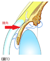 閉塞隅角緑内障